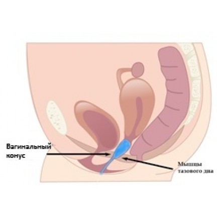 Вагинальный конус для упражнений Кегеля 95 гр